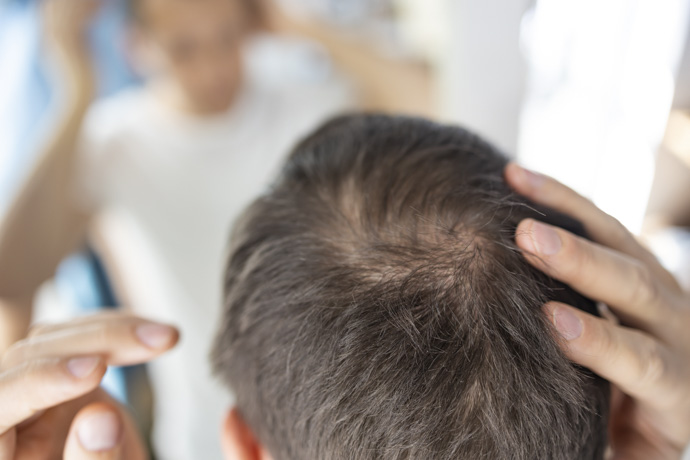 Caída del cabello como consecuencia de la ferritina baja con hierro normal.