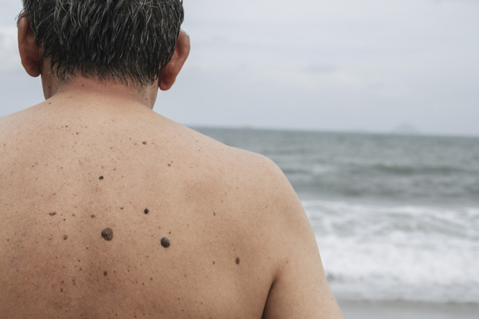 Hombre con manchas marrones en la espalda