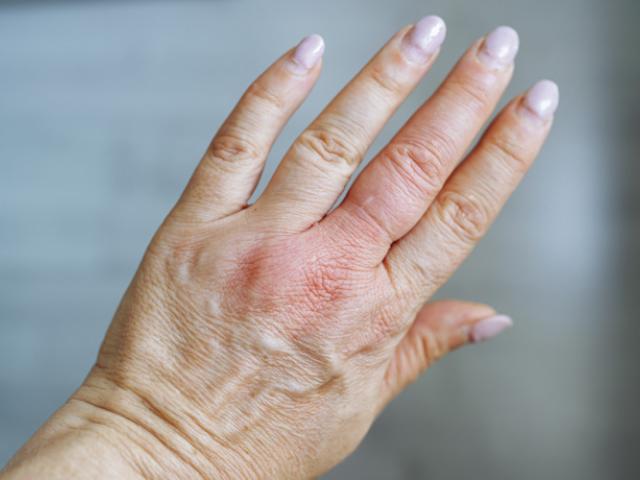 Mano de mujer inflamada por una picadura de avispa  