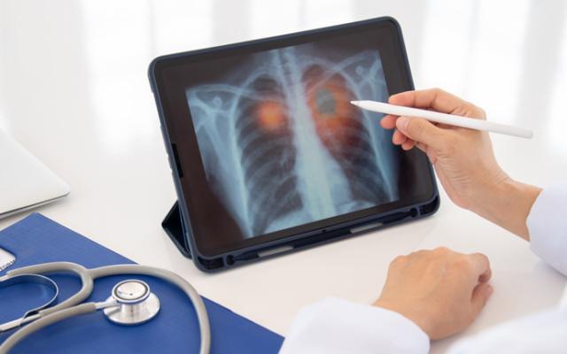 Médico explicando cómo limpiar los pulmones de tabaco con una radiografía.