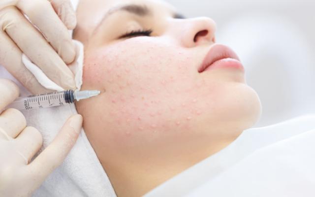 Mujer en tratamiento de mesoterapia